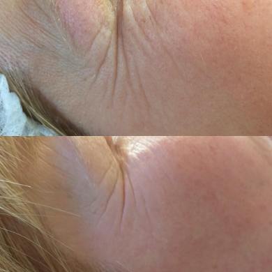 Microneedling 3